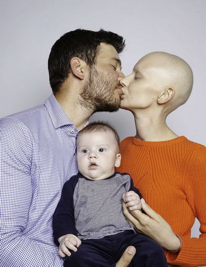 Невероятные фотографии модели, потерявшей челюсть из-за рака - ФОТО