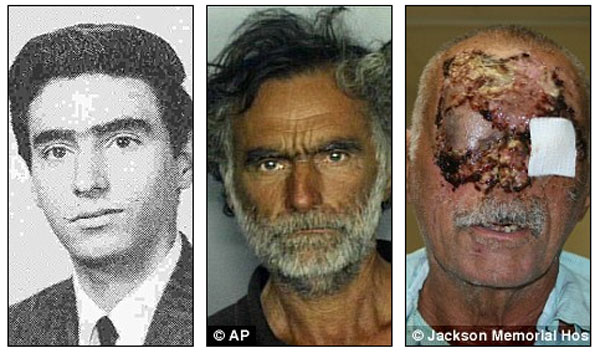 ШОК! Врачи показали американца, лицо которого съел каннибал - ФОТО