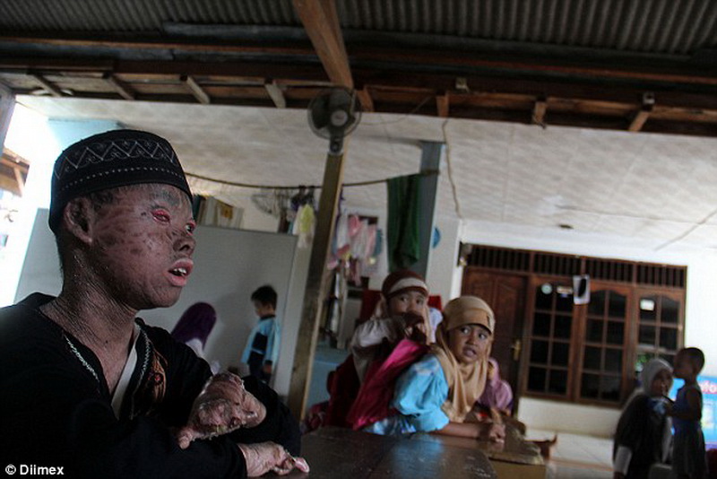 Мальчик-змея каждые два дня сбрасывает свою кожу - ФОТО