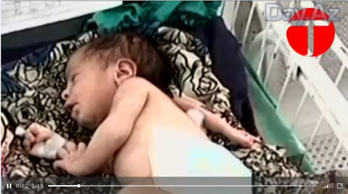 В Пакистане родилась девочка с третьей рукой на спине - ВИДЕО