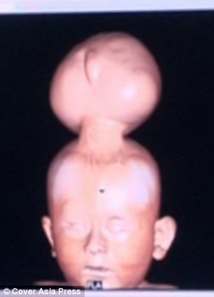 Шок: в Индии родился мальчик с двумя головами - ОБНОВЛЕНО - ВИДЕО - ФОТО