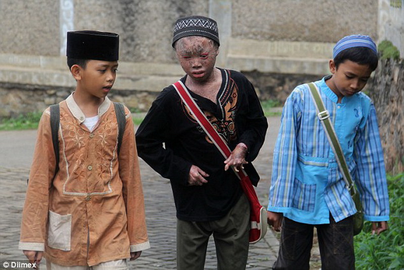 Мальчик-змея каждые два дня сбрасывает свою кожу - ФОТО