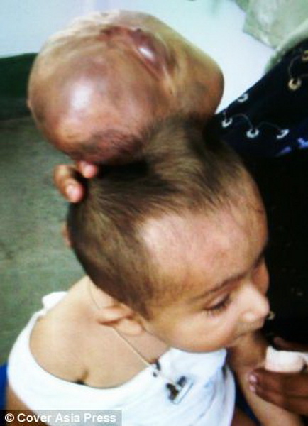 Шок: в Индии родился мальчик с двумя головами - ОБНОВЛЕНО - ВИДЕО - ФОТО