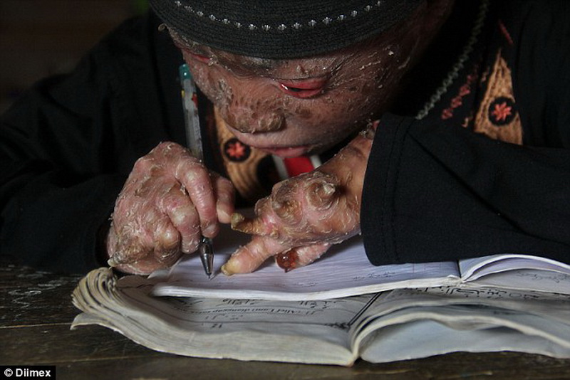 Мальчик-змея каждые два дня сбрасывает свою кожу - ФОТО