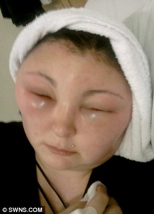 Краска для волос вызвала страшную реакцию у 25-летней британки - ФОТО