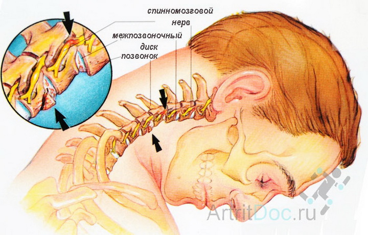 Восемь упражнений против шейного остеохондроза