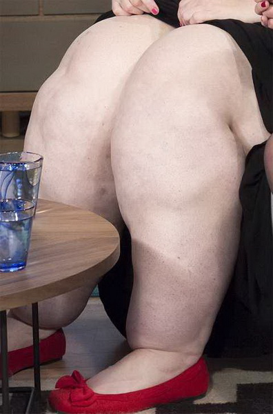 Редкое заболевание раздуло ноги женщины до 63 кг - ФОТО