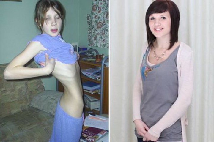 Когда худоба – это страшно - ФОТОСЕССИЯ